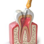 Endodontics Unpacked: A General Dentist’s Guide to Mastering Root Canal Therapy