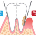 Periodontal Probe