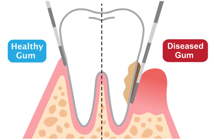 Periodontal Probe
