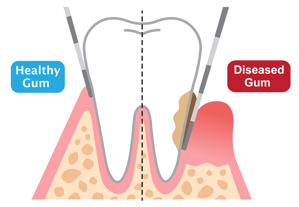 Periodontal Probe