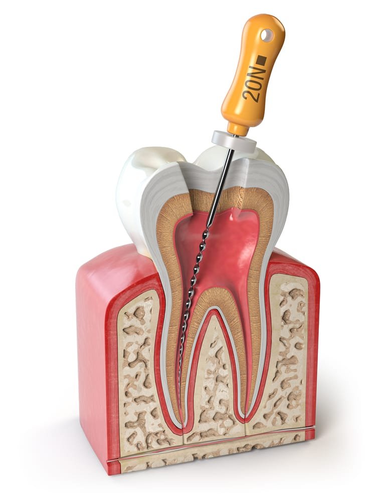 Demystifying Dental Procedures 101: Understanding Root Canal Treatment