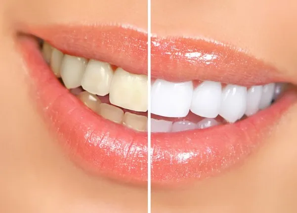 How Long Does Teeth Whitening Last?