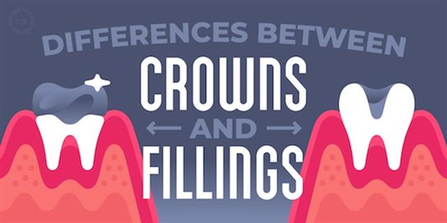 Dental Crown vs. Filling: Which One Is Right for You?