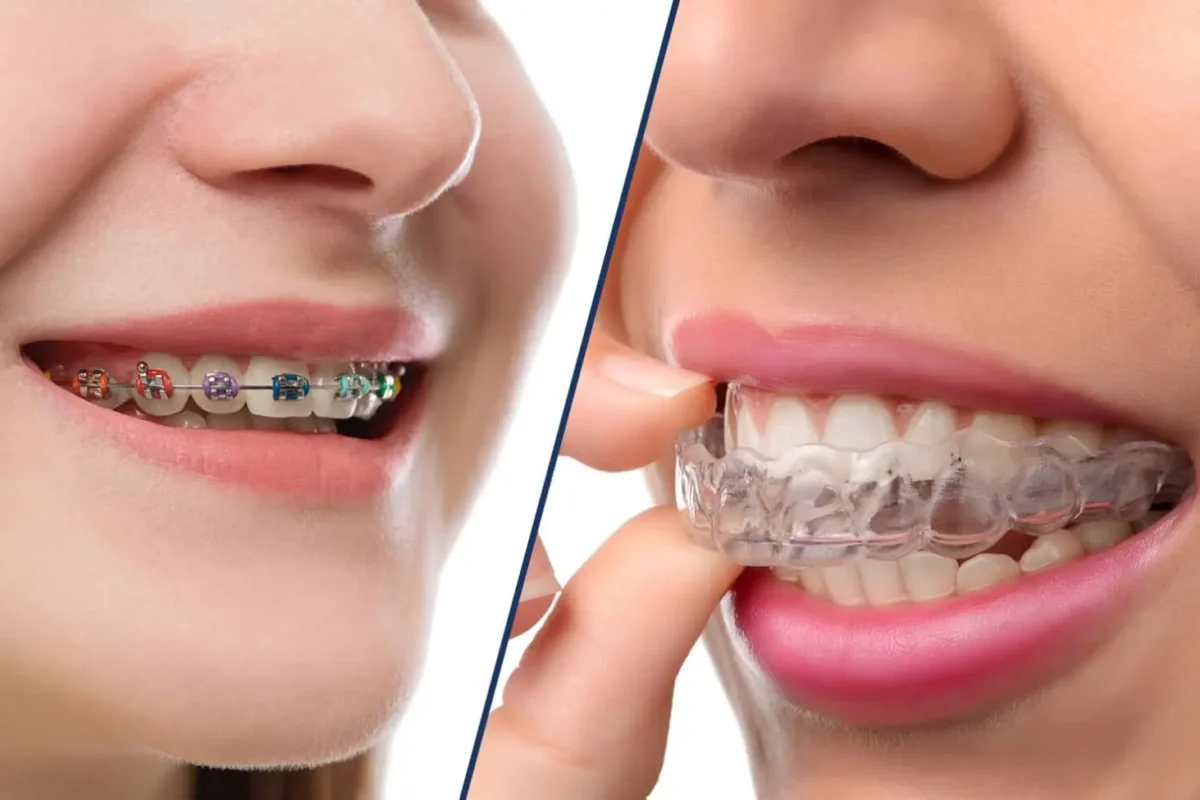 invisalign vs braces
