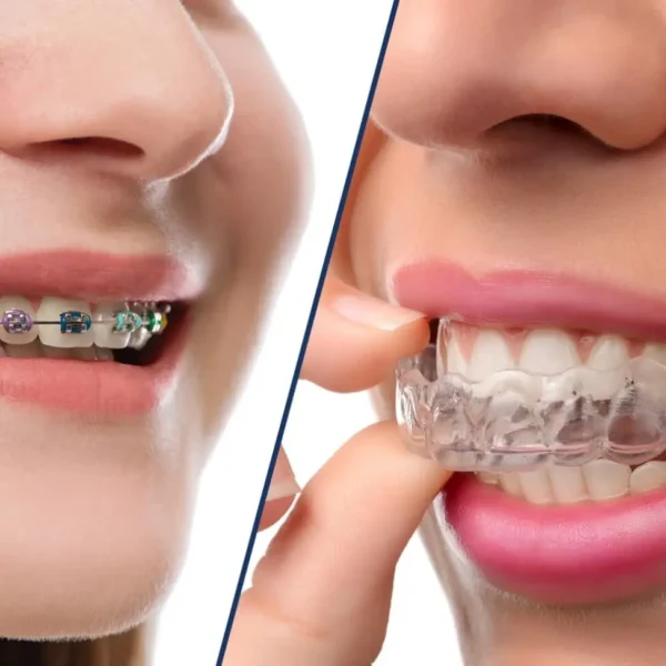 What Is Better, Invisalign or Braces? A Realistic Comparison for Your Smile