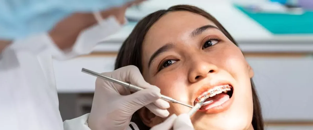 How Long Does It Take to Get Braces?