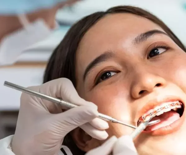 How Long Does It Take to Get Braces?