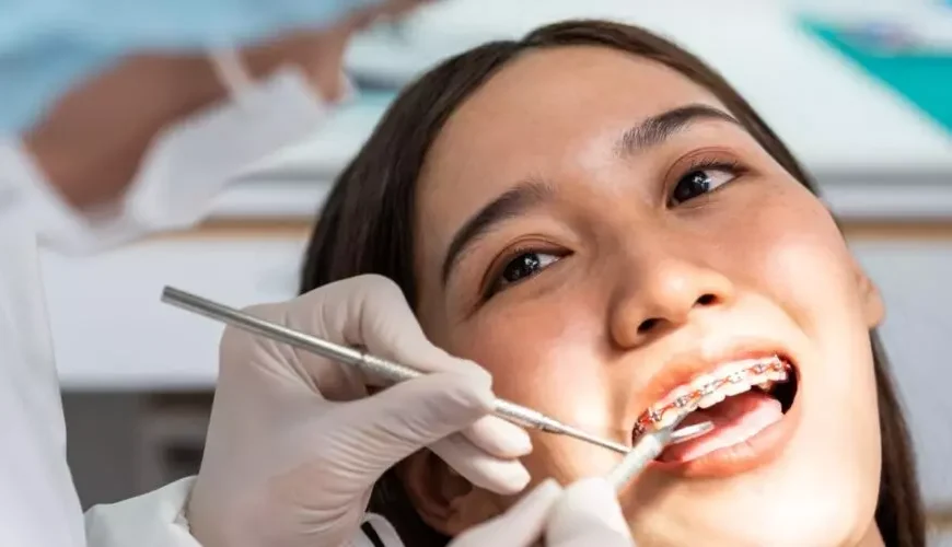 How Long Does It Take to Get Braces? Full Timeline Explained