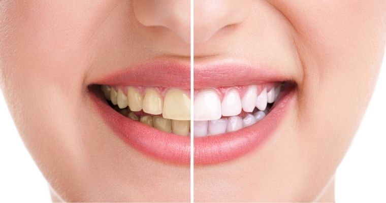 How much does teeth whitening cost