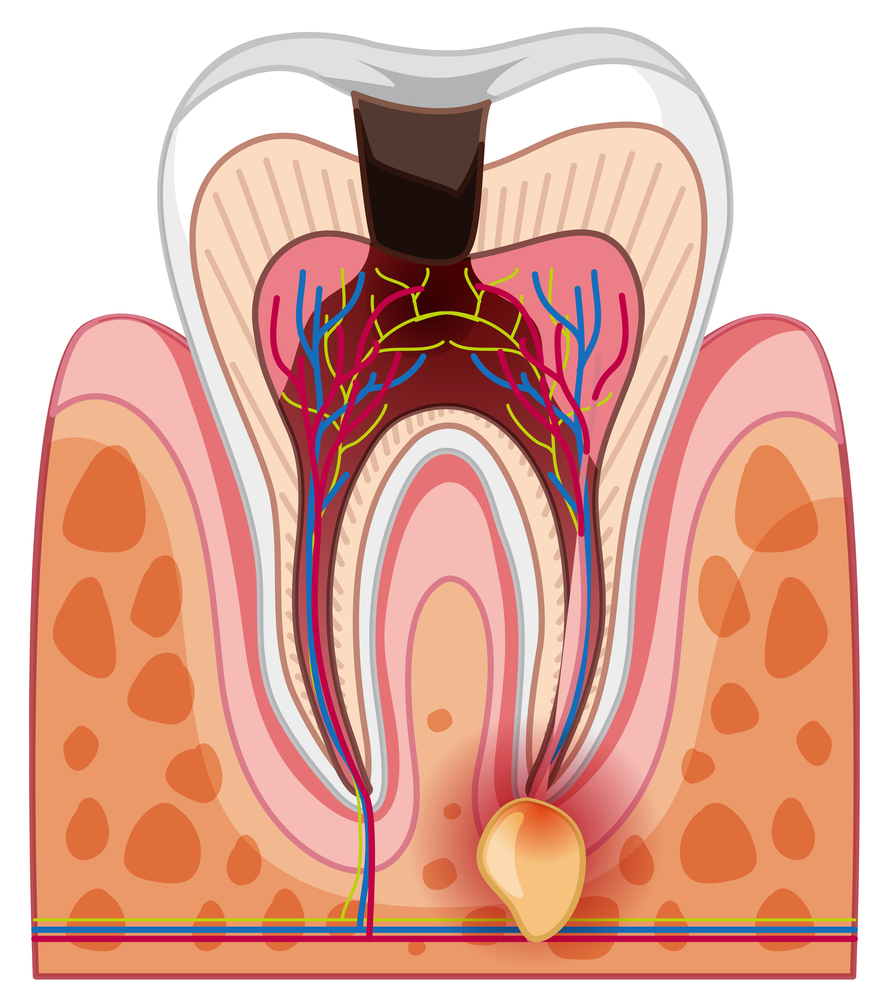 Why Is Root Canal Treatment Essential for Tooth Preservation?